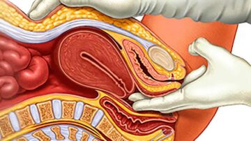 ¿Pueden los fibromas uterinos afectar el embarazo?