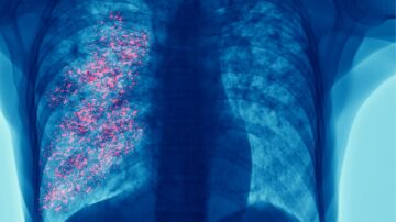 El cáncer de pulmón sigue siendo la principal causa de muerte por cáncer: la detección temprana es clave para cambiar esta realidad